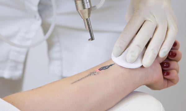 Factors that determine the success of tattoo removal