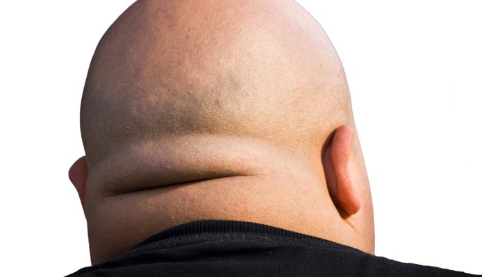 Steps To Burn The Neck And Chin Fat
