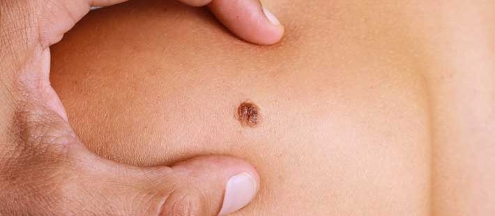 How to Naturally Remove a Skin Tag